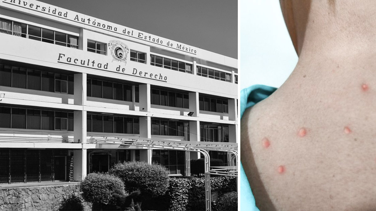 viruela-del-mono-facultad-derecho-uaemex