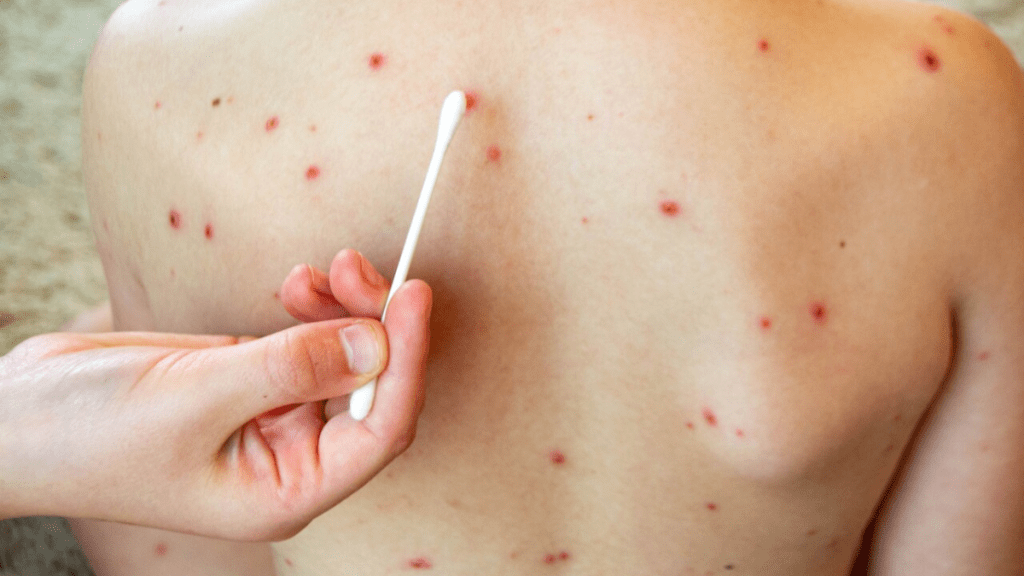 vacunación contra el sarampión edomex