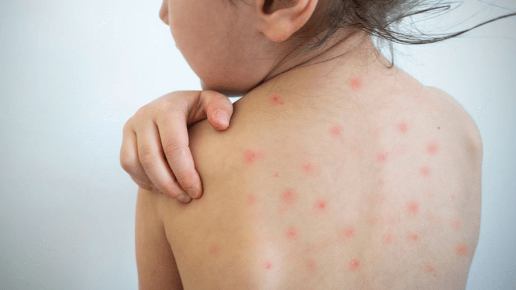 Close-up of a child's back with visible red spots and slight irritation, suggesting a skin condition.