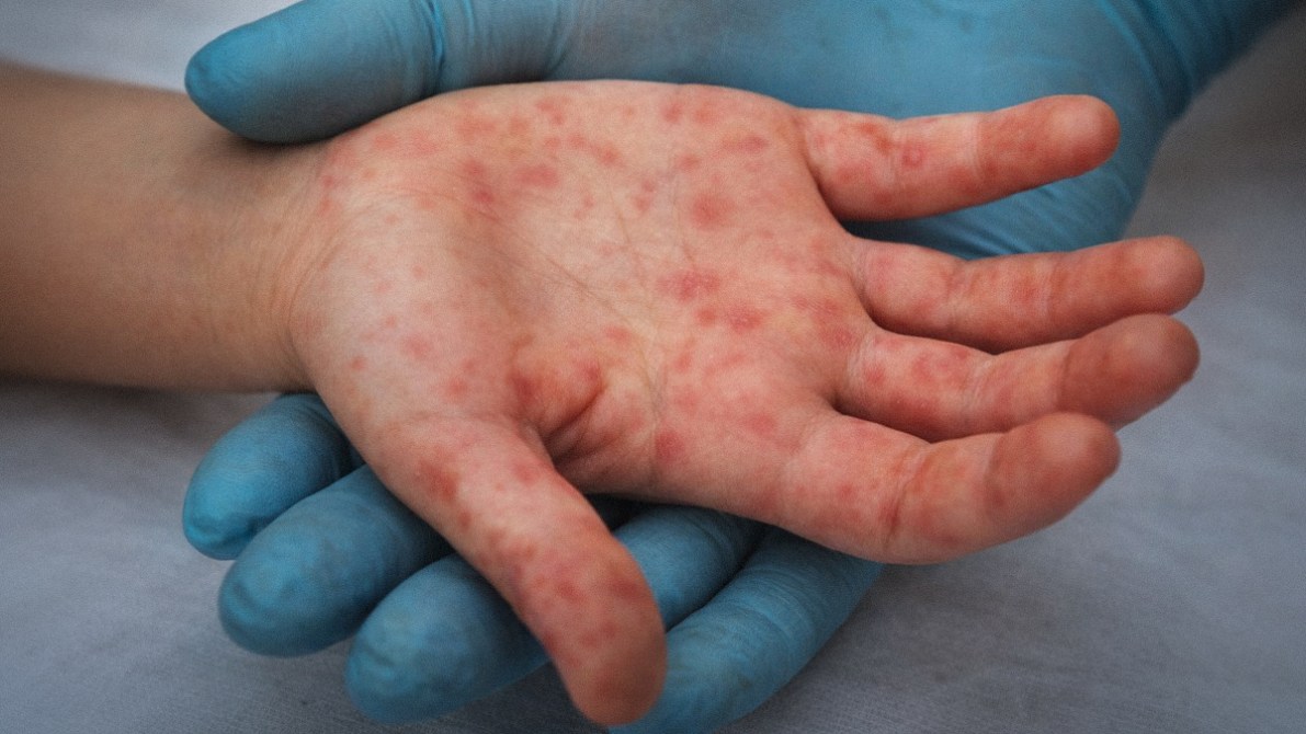 Una mano de un niño con lesiones cutáneas rojas, sostenida por una mano con guante azul, sobre una superficie clara.